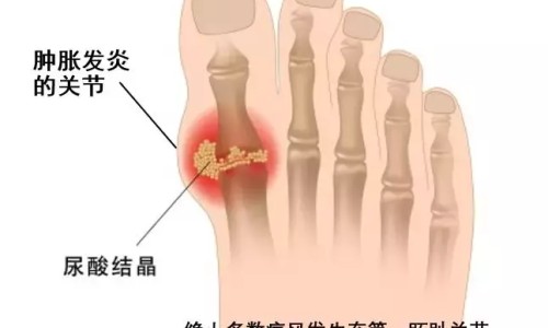艾滋病关节会疼吗-艾滋病人是身体合关节疼吗网 :分享艾滋病关节会疼吗-艾滋病引起的关节疼是全身的吗知识